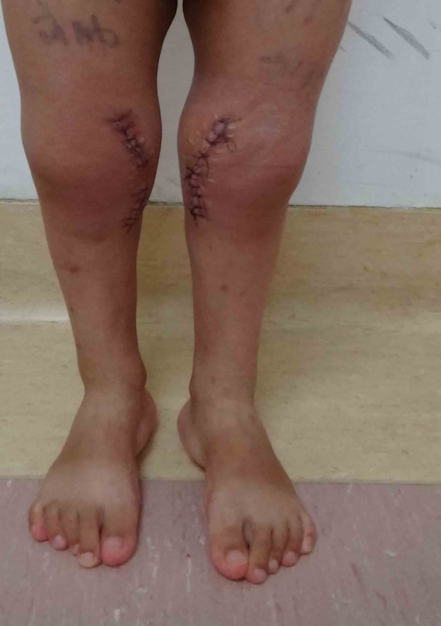 x型腿如何治疗?