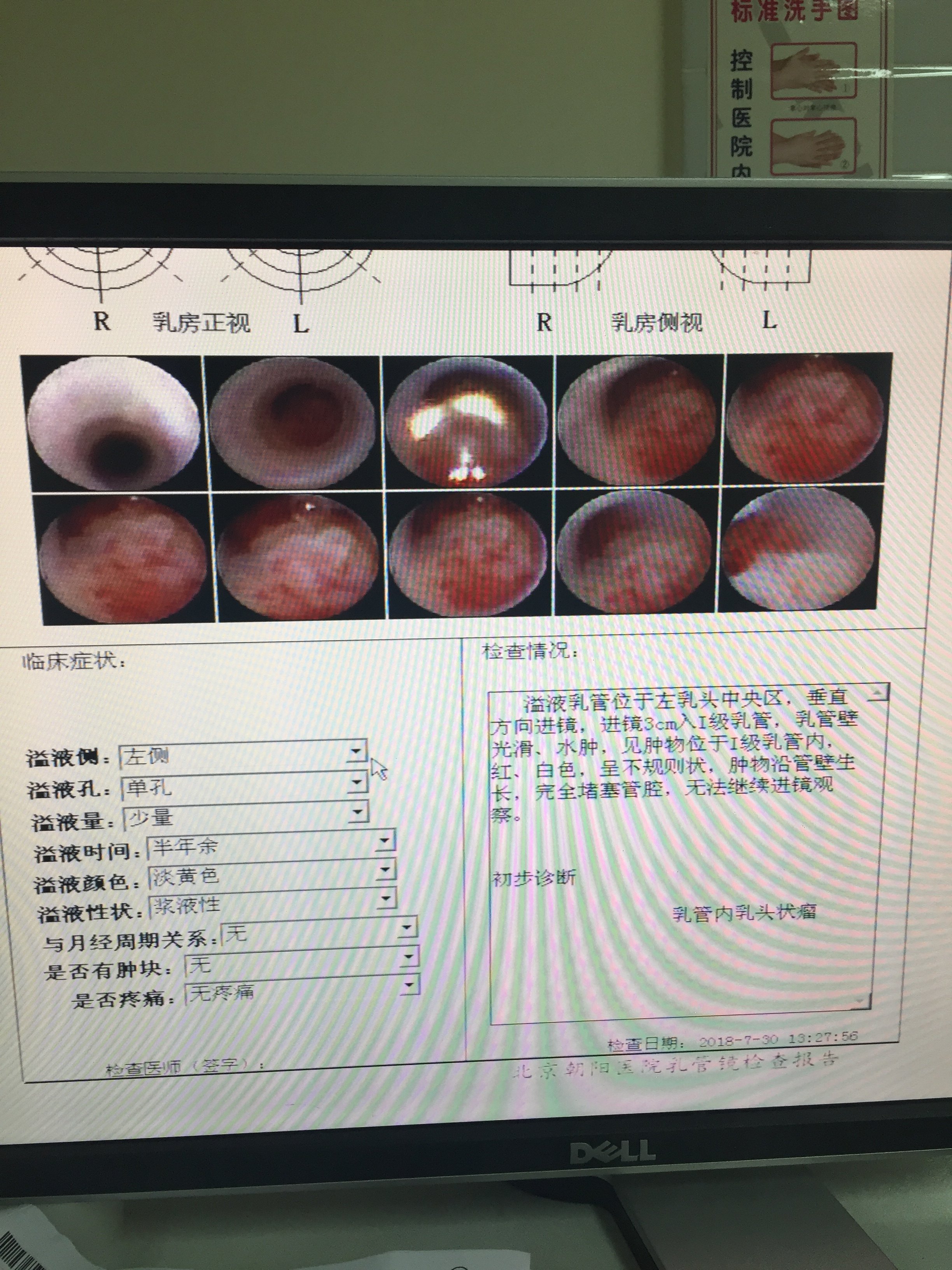 乳管镜检查乳头溢液乳管内乳头状瘤