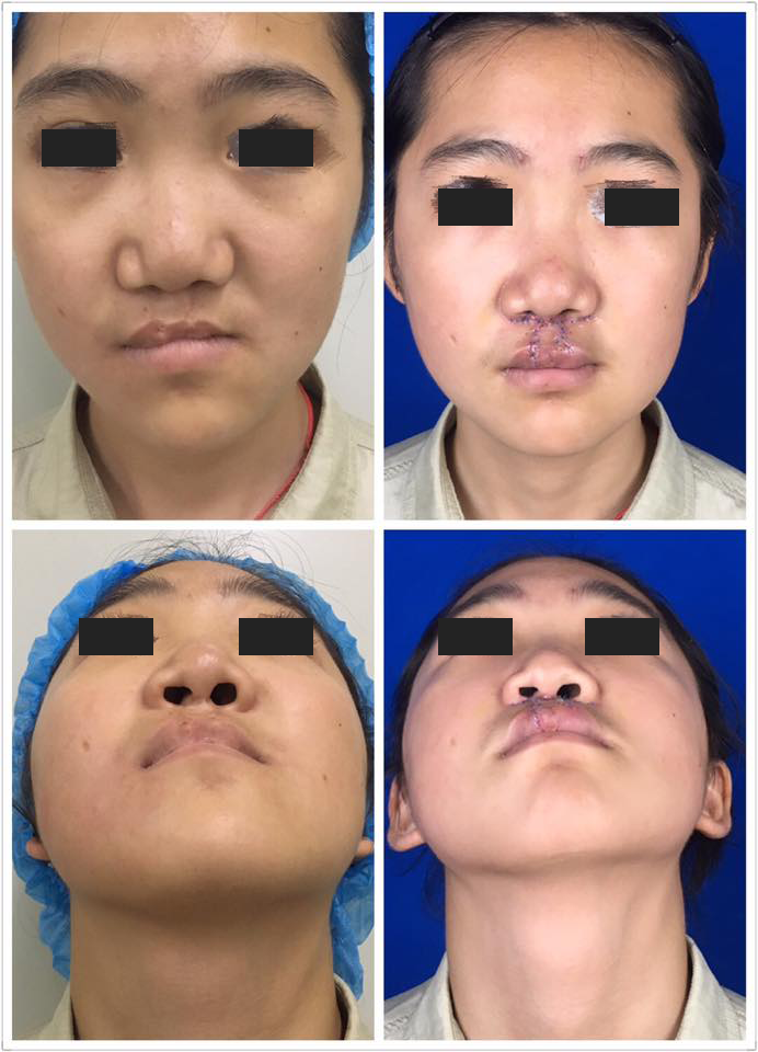 柴岗教授近期唇裂修复手术两例(4)
