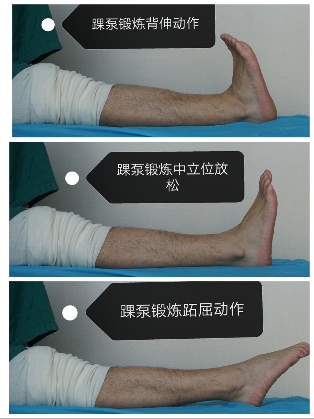 胫骨平台骨折术后康复训练计划 康复一家 胫骨平台骨折术后康复训练计划 康复一家