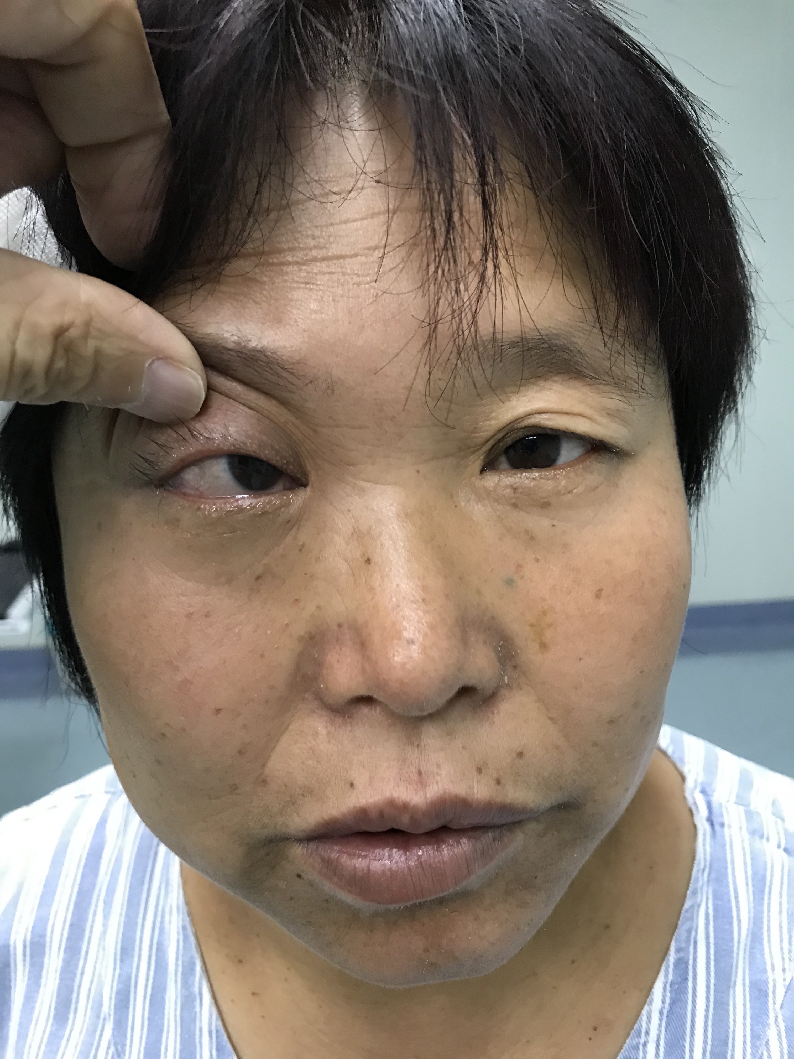 眼眶内肿瘤切除术医者版