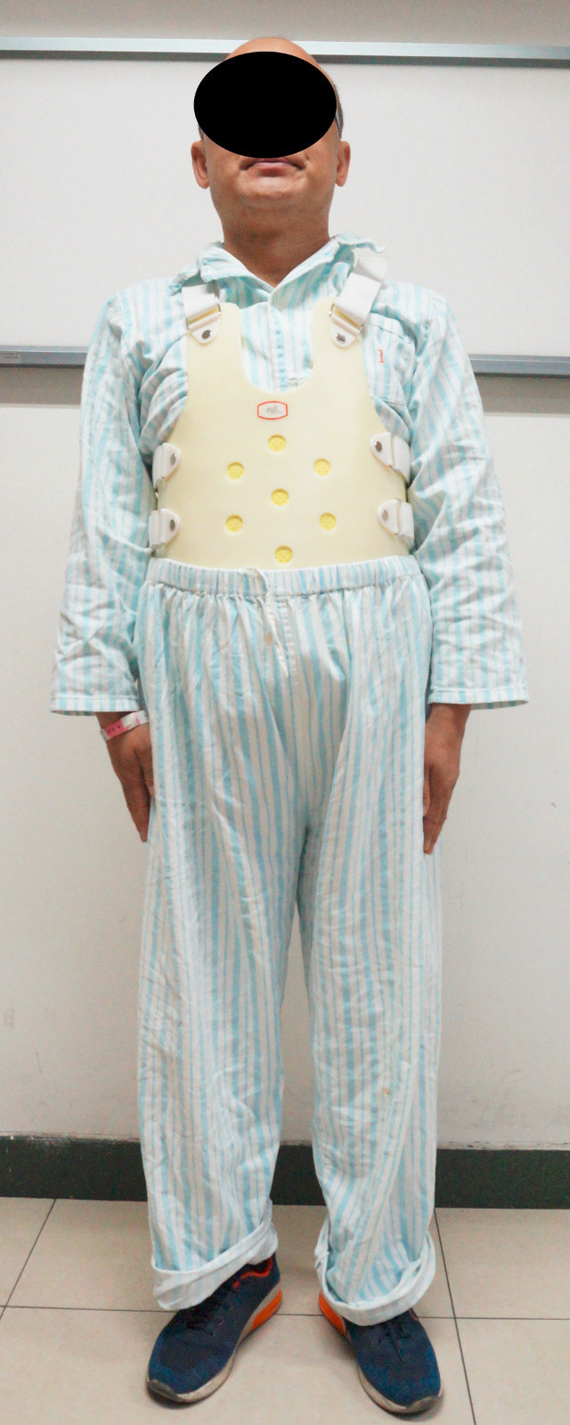 超声骨刀在陈旧性脊柱结核后凸畸形矫形手术中的应用 - 好大夫在线