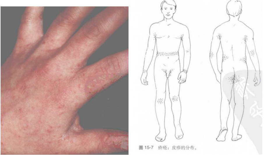 所以我们皮肤科医生怀疑患者有疥疮,首先是看手指间有没有皮疹.