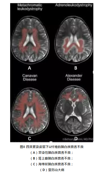 脑白质病变的鉴别诊断:皮层下u纤维的秘密 好大夫在线