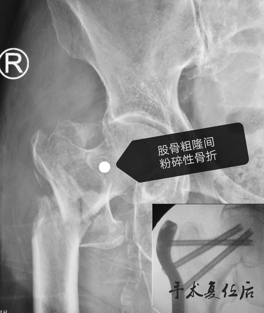 年纪大的老人(髋)胯部骨折,保守好还是手术好,手术风险大_骨折_手术