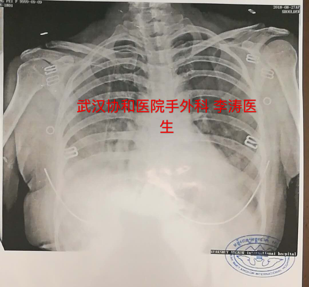 中国游客柬埔寨外伤致骨折协和医生接力完美修复 中国游客柬埔寨外伤致骨折协和医生接力完美修复