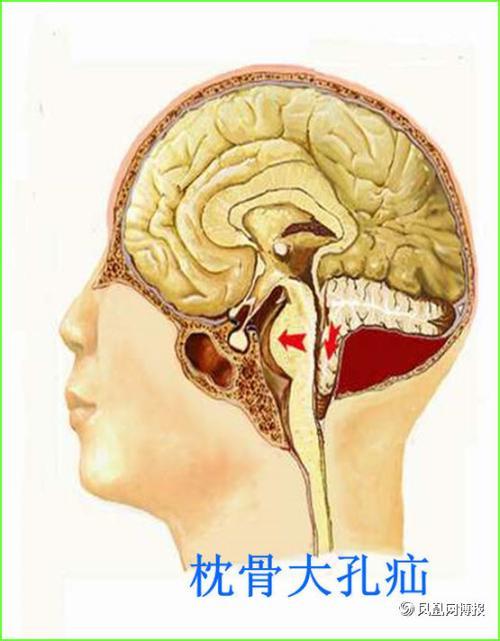 腰椎穿刺术中(术后)脑疝 - 好大夫在线