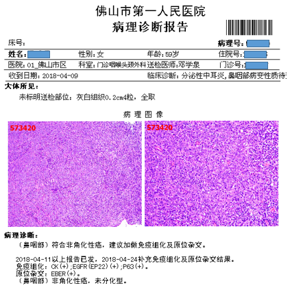 个案分享耳朵闷塞似进水警惕鼻咽癌