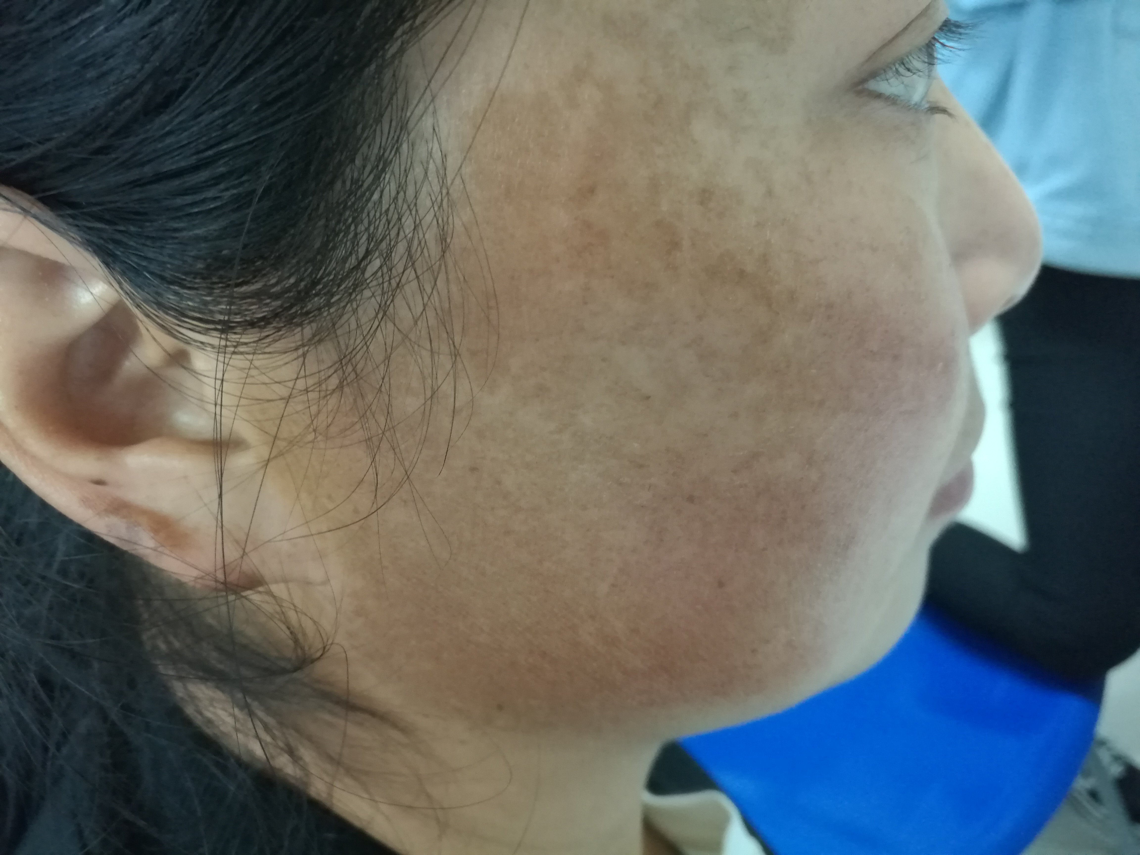 该病主要发生于中年女性,表现为面颊部对称性片状浅褐色的色素沉着斑
