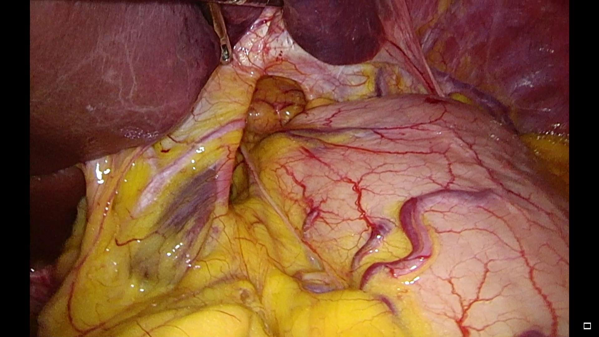 胃食管反流病小故事之--午夜的濒死感