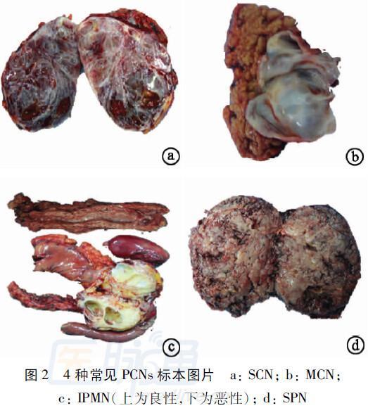 彩超說我是胰腺囊性病變怎麼辦