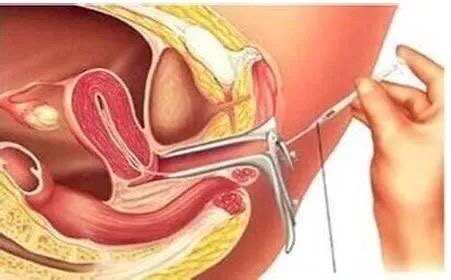 女性生殖器 二 你看不到的内生殖器到底是怎样的呢 不孕症 疾病介绍