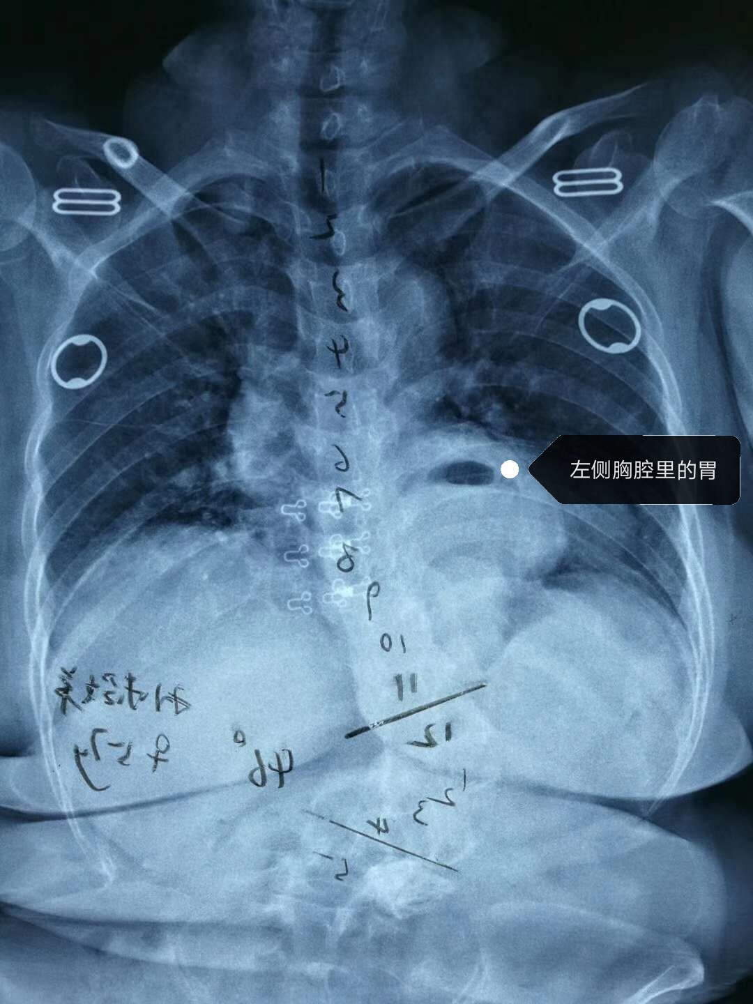 員 崔玉豔李俊生主任醫師介紹,分隔人體胸腔和腹腔的膈肌上有個孔洞