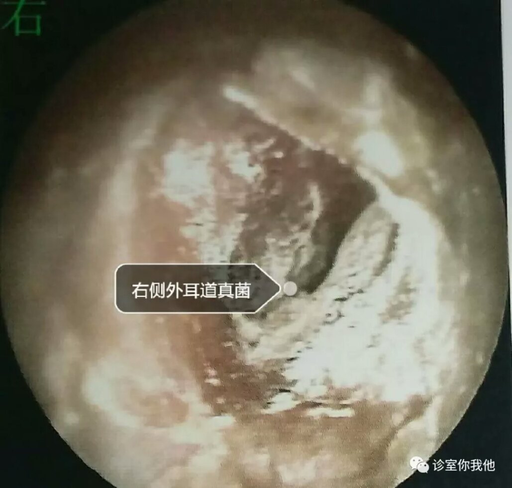 真菌性外耳道炎如何治疗 外耳道真菌病 病因 症状 治疗方法 预防 真菌性外耳道炎如何治疗 外耳道真菌病 病因 症状 治疗方法 预防