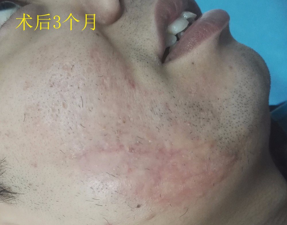 张博文 术后3个月.jpg