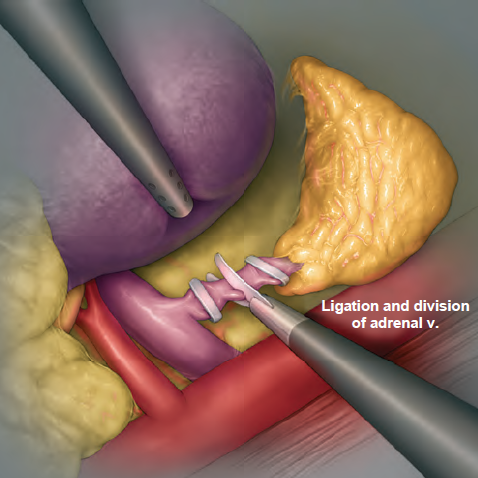 肾上腺切除对身体有影响吗? - 好大夫在线
