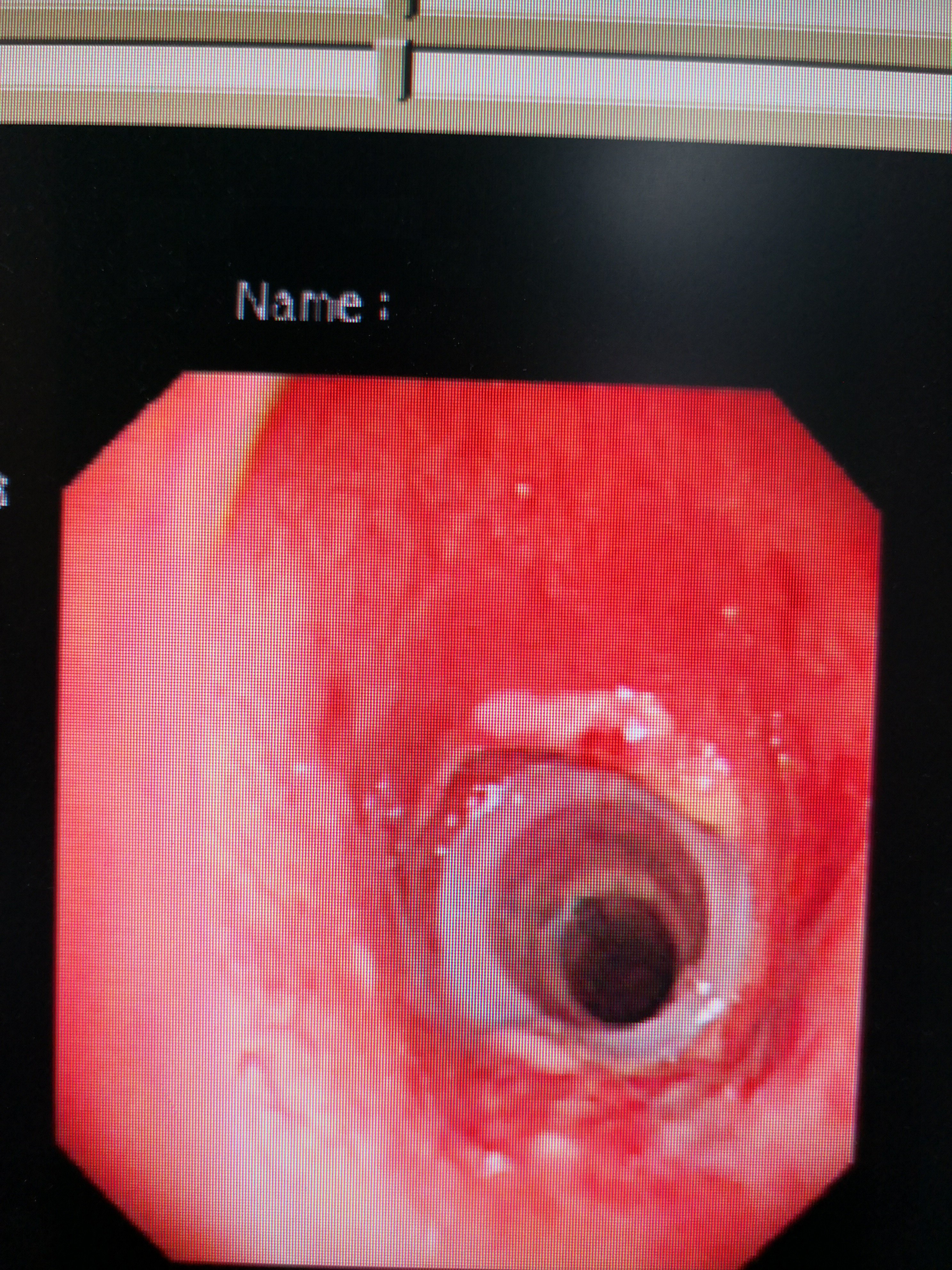气管支架图片 后遗症图片