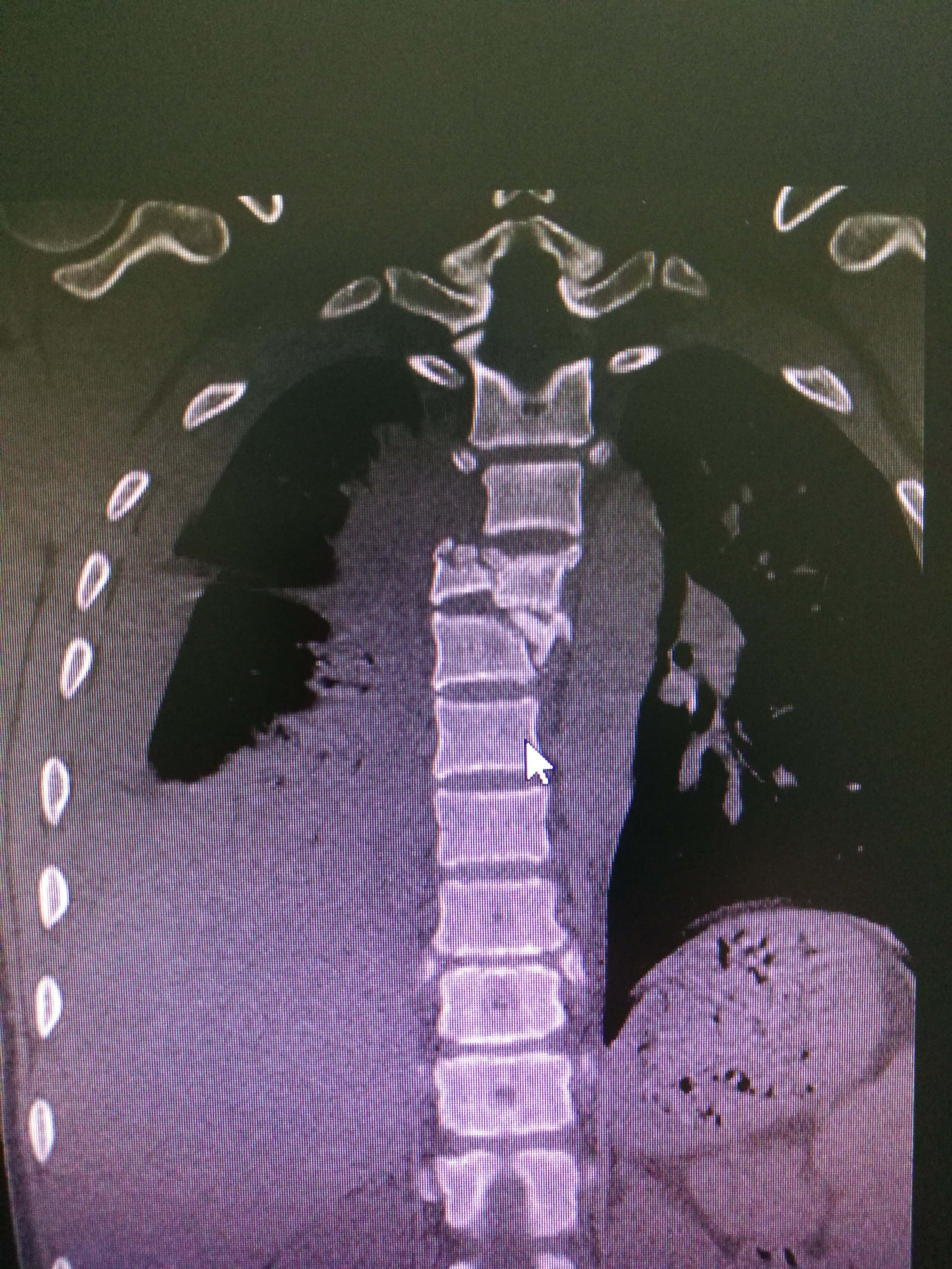 胸椎骨折图片图片