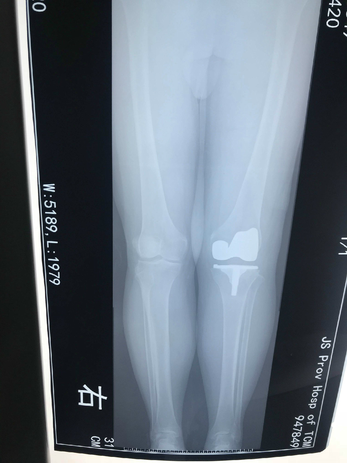 外翻膝-x型腿的多种治疗方法 - 好大夫在线