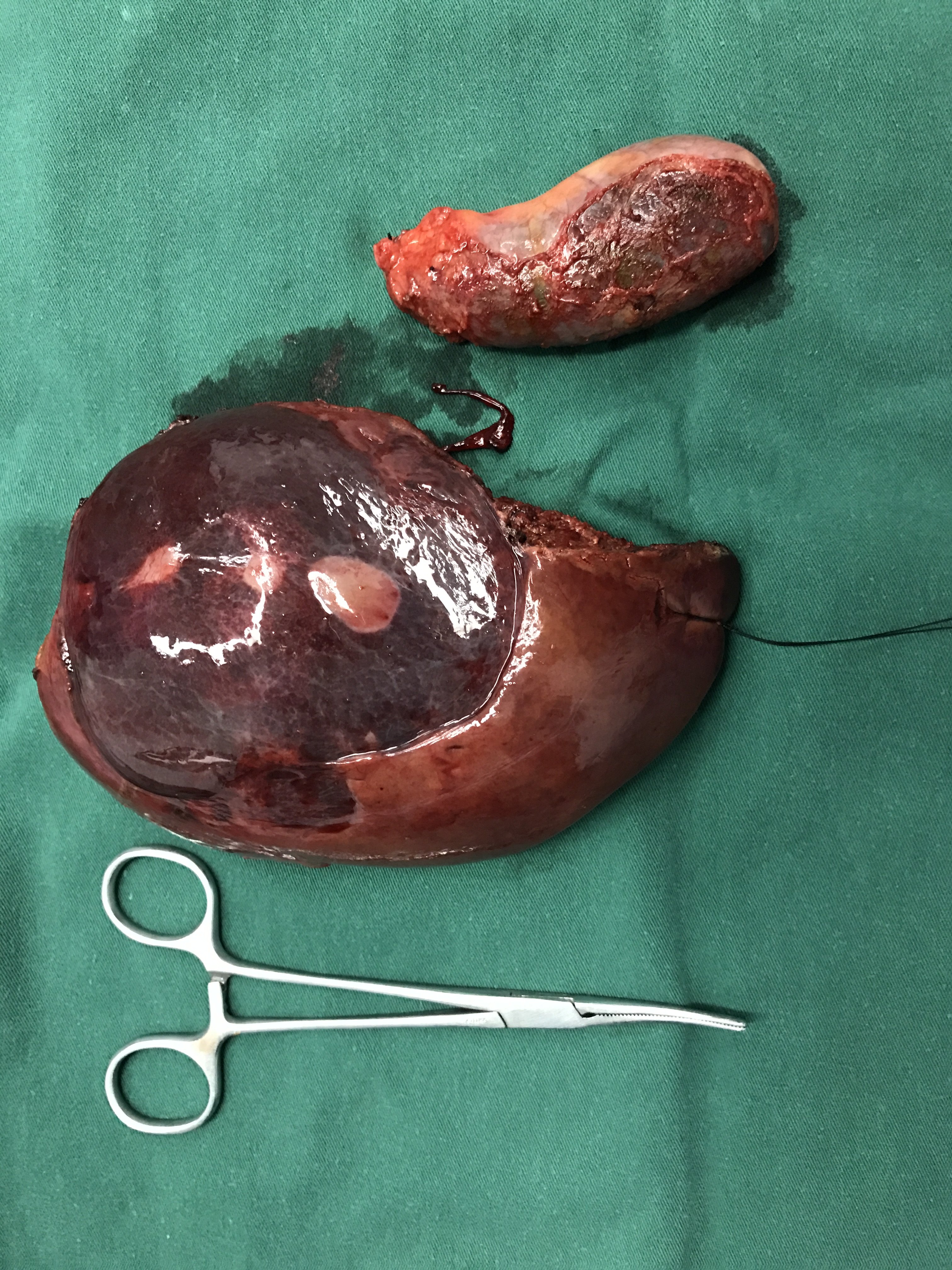 肝脏血管瘤手术治疗图片分享 