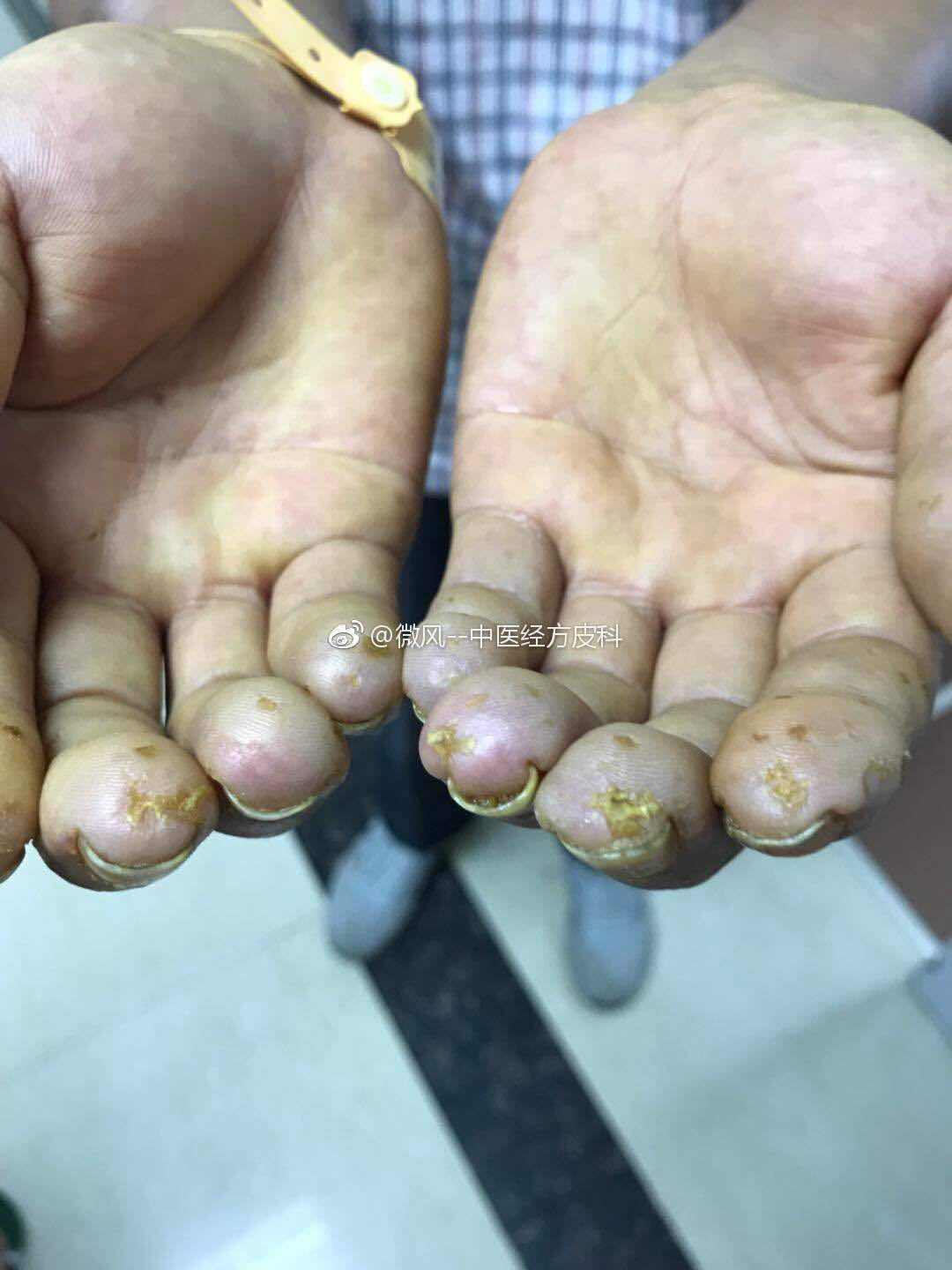 狼疮;1)全身性硬皮病;皮肤科见于(疾病晚期,逐渐出现手指背面汗毛消失