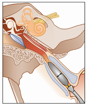 咽鼓管球囊扩张术在鼻咽癌放疗后分泌性中耳炎治疗中的作用 - 好大夫