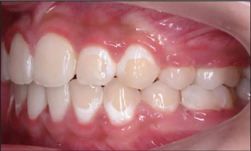 牙龈白斑癌变图片