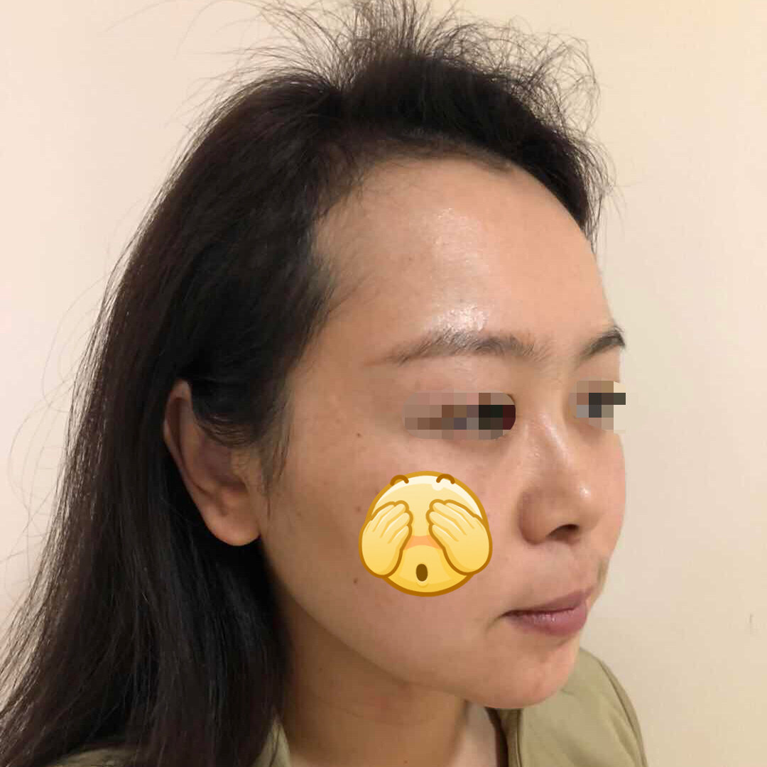 自体软骨综合鼻及下巴整形(九院核心技术,全球首例报道)