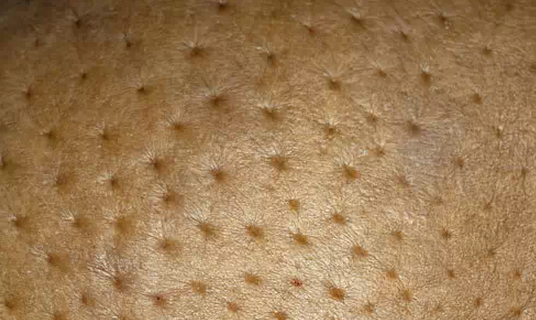 乳房皮肤褶皱图片