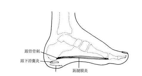 跟骨滑囊炎会反复发作吗? 