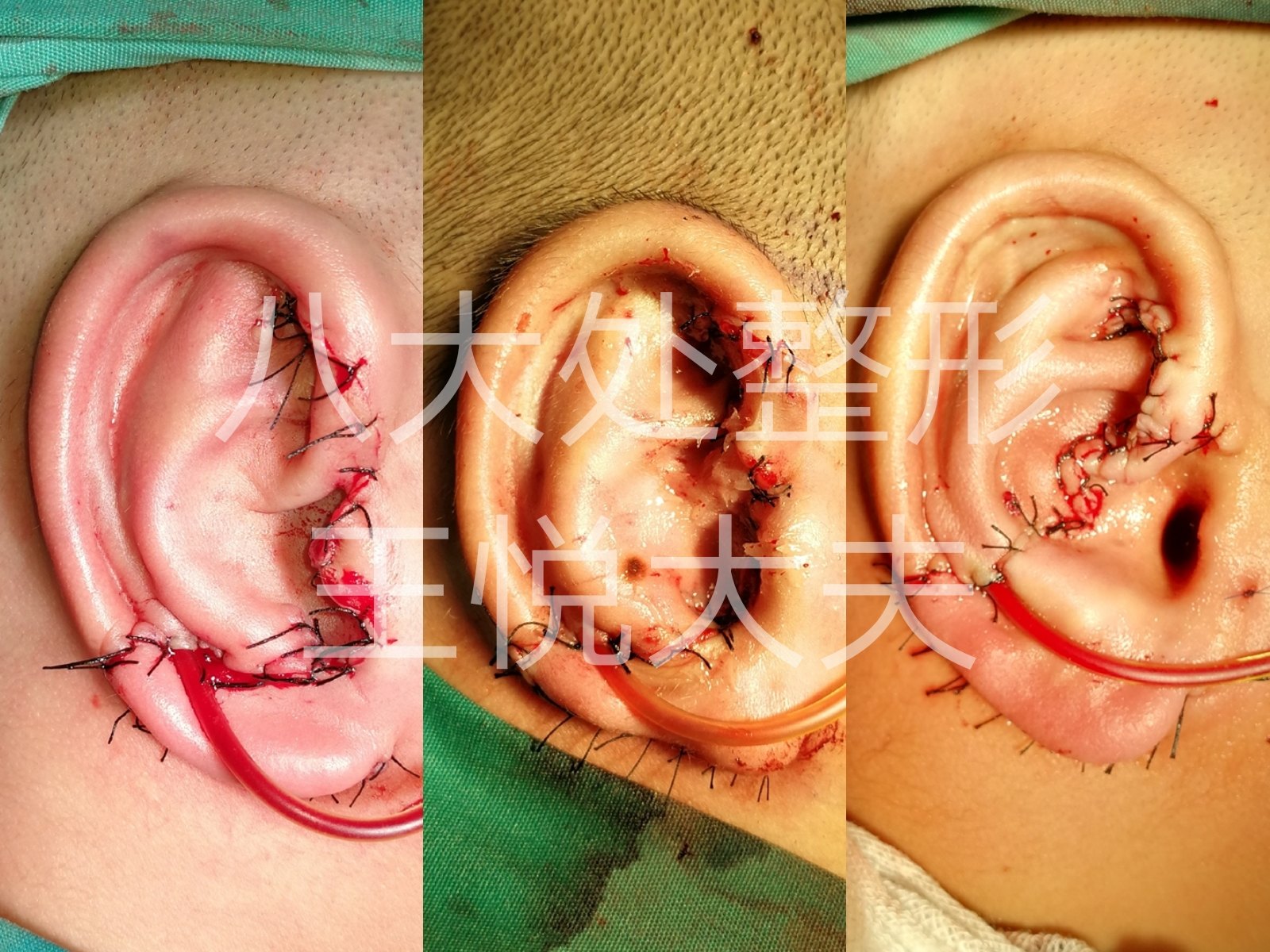 小耳再造手术的选择精华版_小耳畸形_手术_治疗方式_治疗介绍 - 好