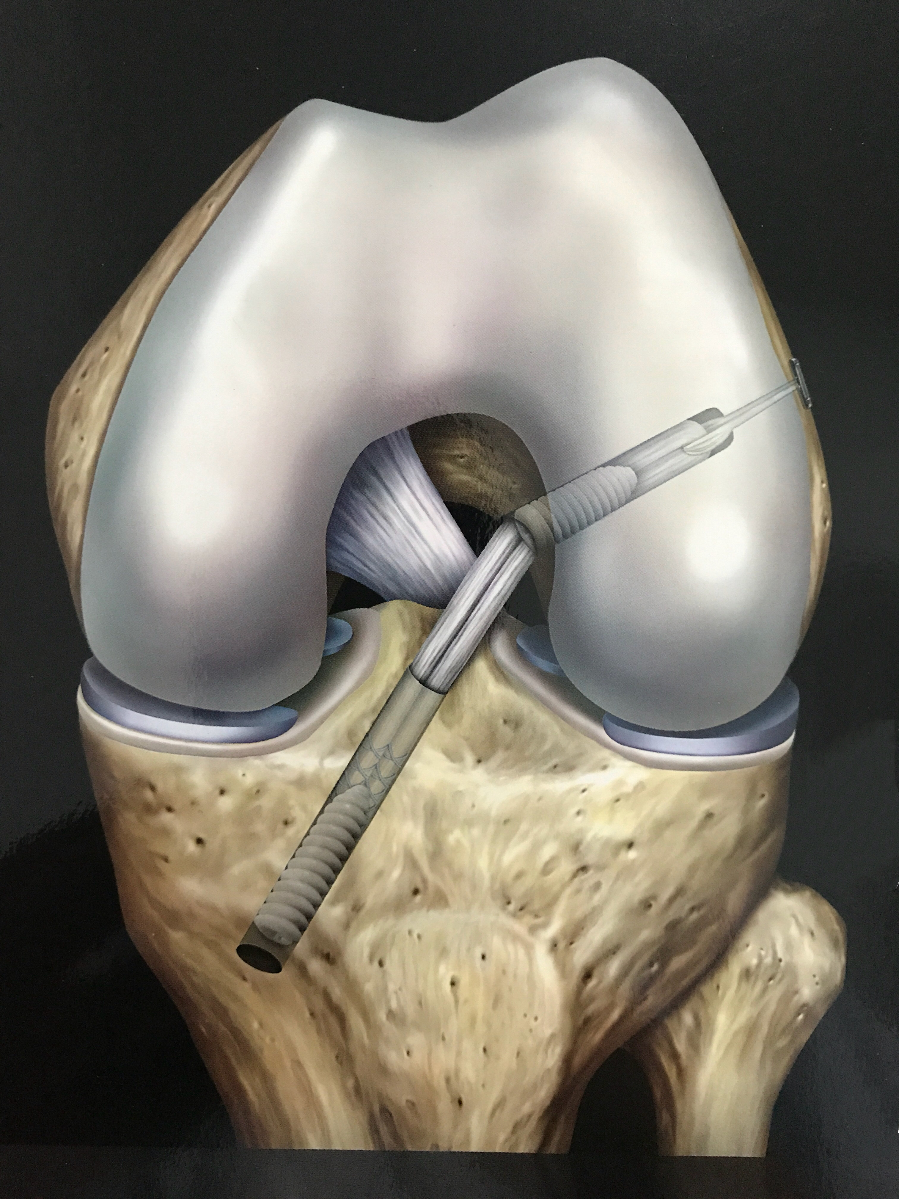 前交叉韧带acl损伤自体肌腱重建病例 好大夫在线 前交叉韧带acl损伤自体肌腱重建病例 好大夫在线