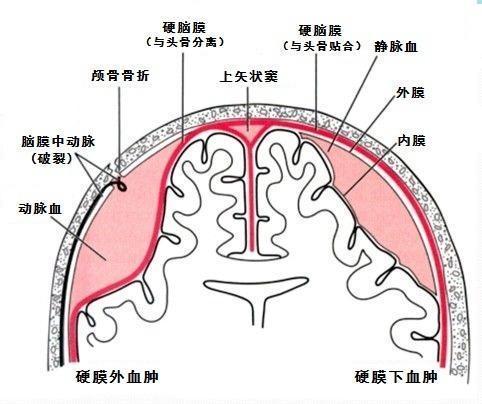 硬脑膜外血肿是位于颅骨内板与硬脑膜之间的血肿,好发于幕上半球凸面