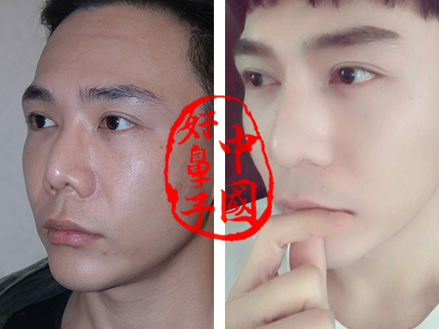 隆鼻整容手术_整容手术隆鼻多少钱_整容手术隆鼻视频
