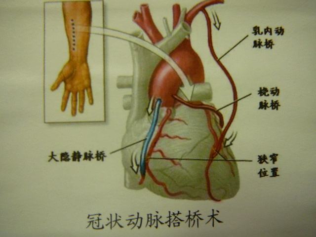 把自身的血管(包括胸腔裡離心臟最近的乳內動脈,大腿上的