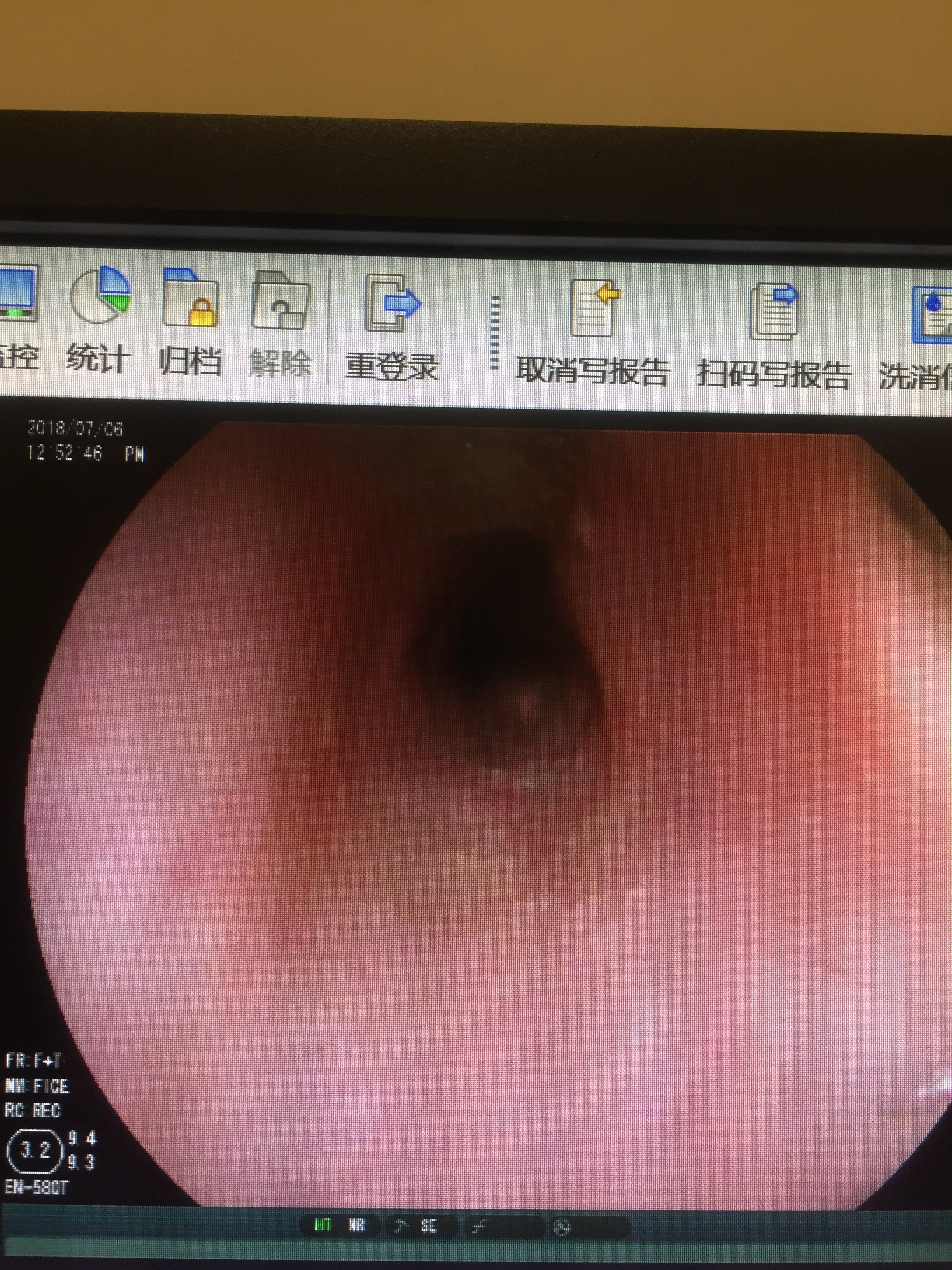 小肠镜检查水平迈向新高度 - 好大夫在线