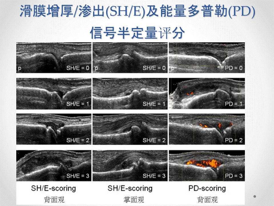 肌骨关节超声帮你找出潜伏亚临床滑膜炎