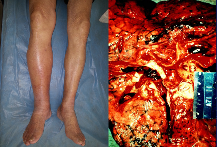 1531722265576254.png 深静脉血栓有哪些表现.png