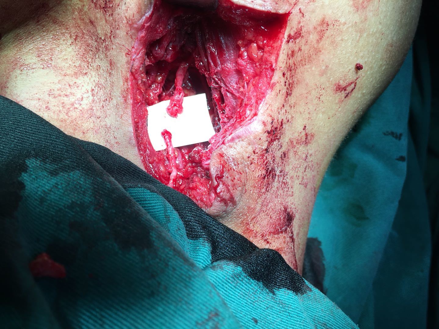 科普时间 神经缝合与神经移植～ - 好大夫在线