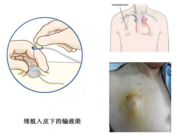 乳腺癌患者化疗常用的静脉输液港是什么 乳腺癌 放化疗