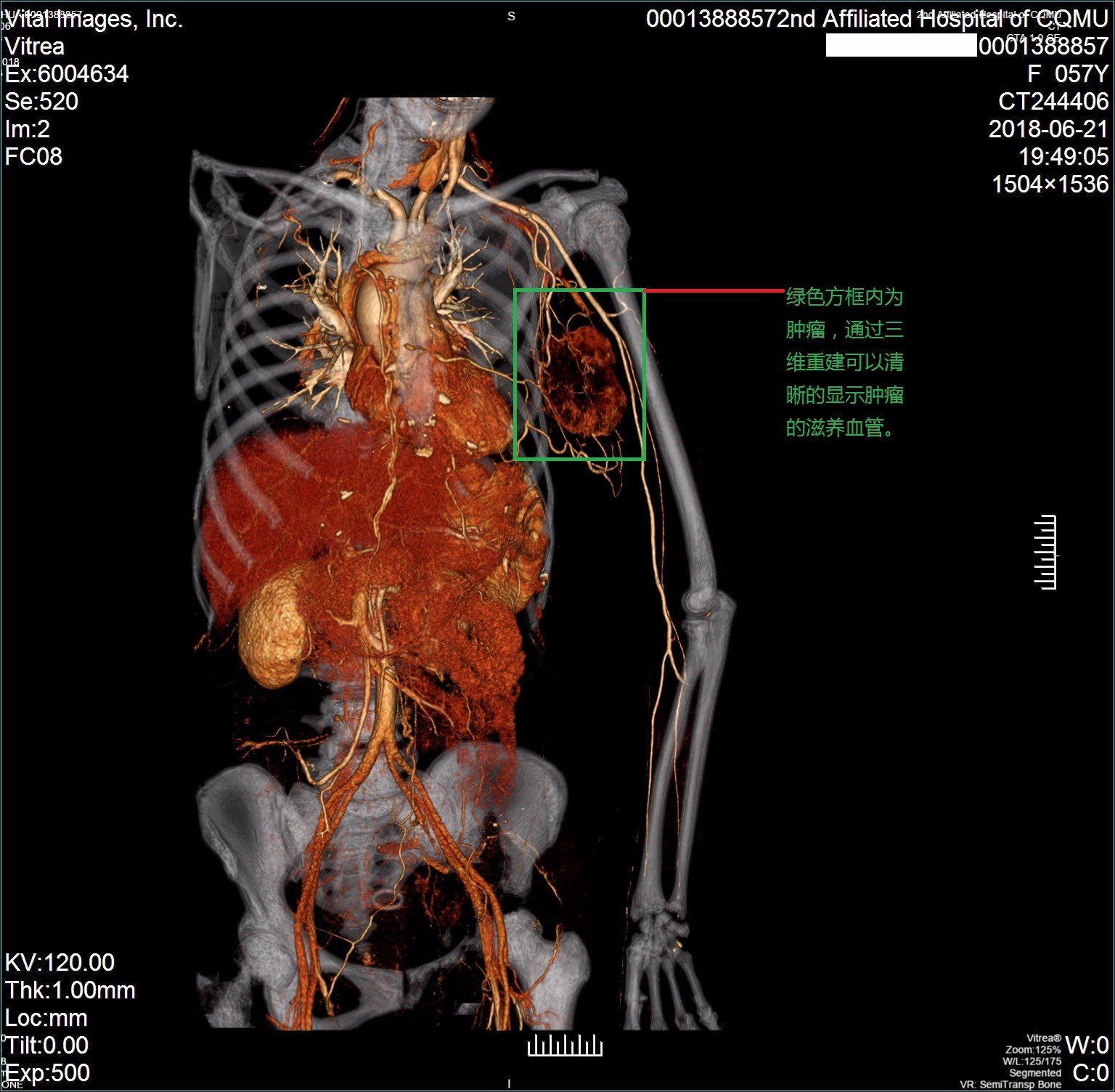 又双叒叕一个菜花状乳腺癌直辖市的市民