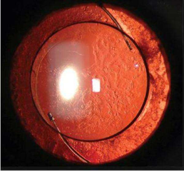 白内障_手术_治疗方式 - 好大夫在线