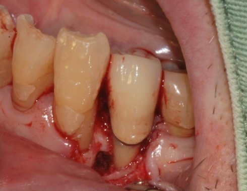 牙周翻瓣手术后牙间隙大 - 好大夫在线