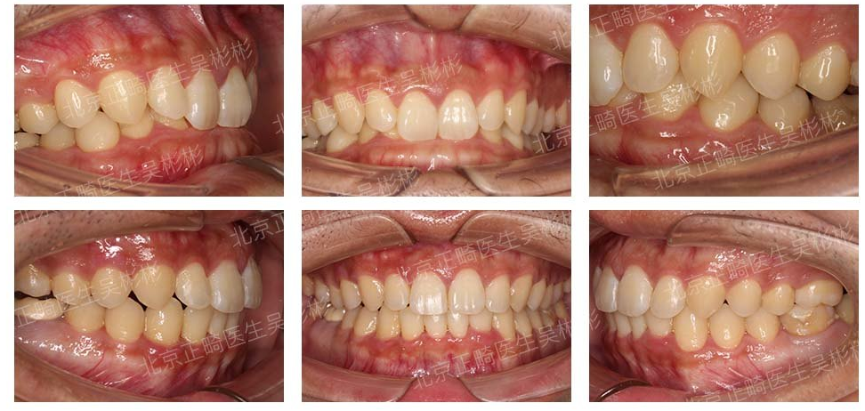 前牙深覆合前牙拥挤非拔牙矫治案例