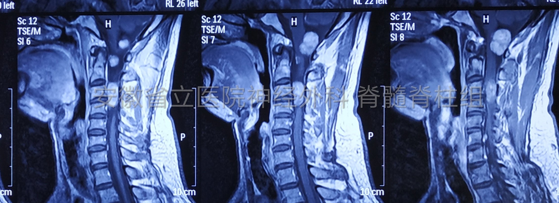 强直性脊柱炎脊柱疼痛难忍_强直性脊柱炎6个地方疼_强直性脊柱炎脊柱痛怎么办