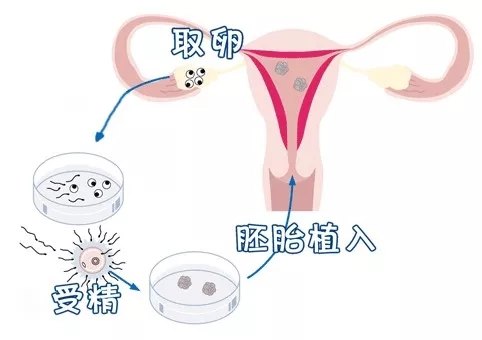 试管婴儿 一代 二代 三代 到底是咋回事 试管婴儿 一代 二代 三代 到底是咋回事