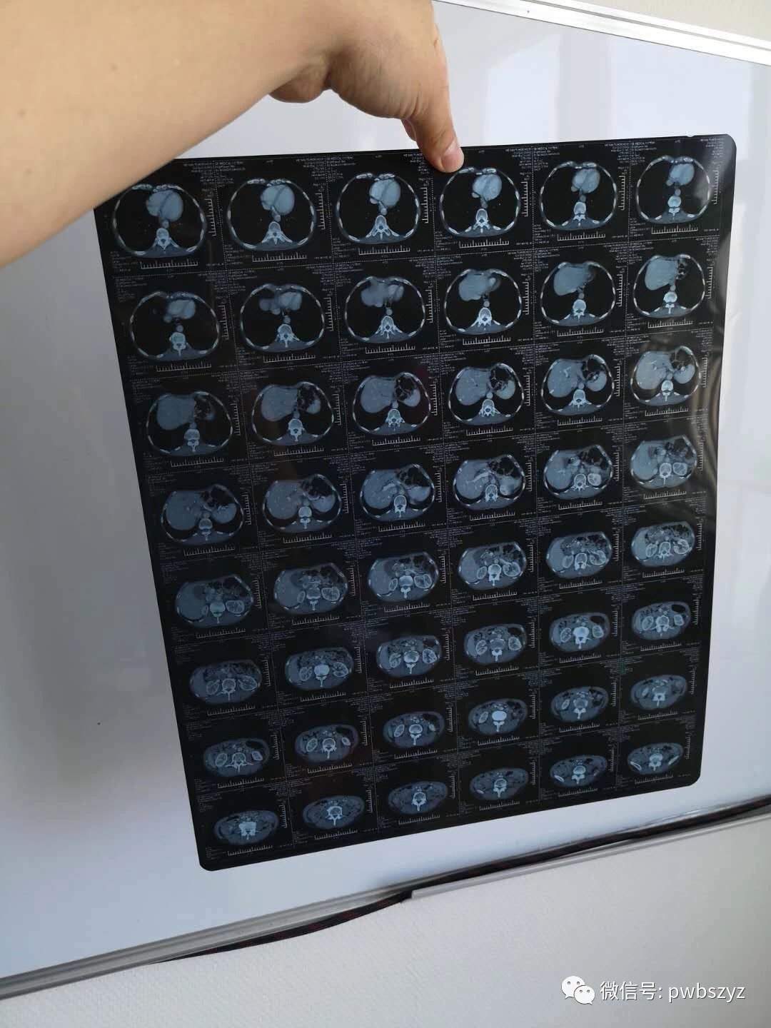 一分钟拍出适合微信会诊的ct影像 - 好大夫在线