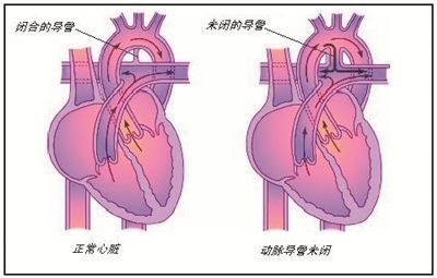 动脉导管未闭手术图片