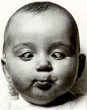 宝宝的斗鸡眼需要处理吗