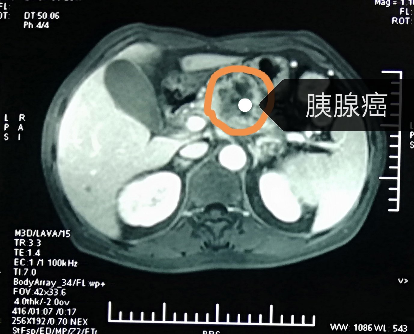 刘某某胰腺癌海扶手术病历分享